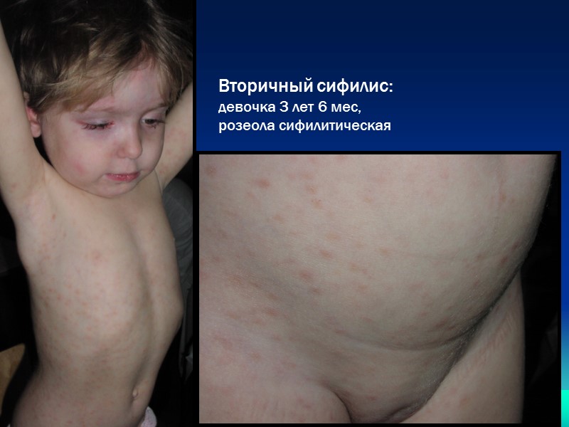 Вторичный сифилис: девочка 3 лет 6 мес,  розеола сифилитическая